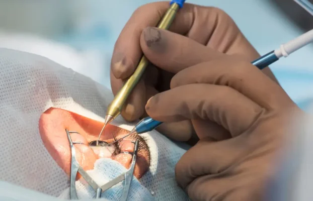 Different Types of Cataract Surgeries and Iols